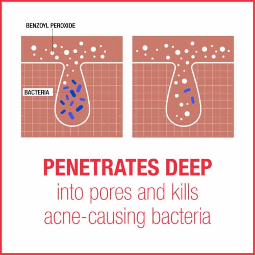 Neutrogena Stubborn Acne Am Treatment Perspective: back