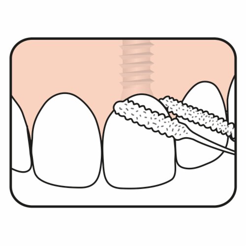 TEPE Bridge Implant Dental Floss - Thick, Flexible with Stiff Ends for Braces, 30 Pcs Perspective: bottom