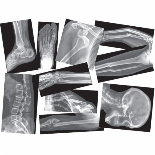 Roylco Broken Bones X-Ray Set Perspective: front