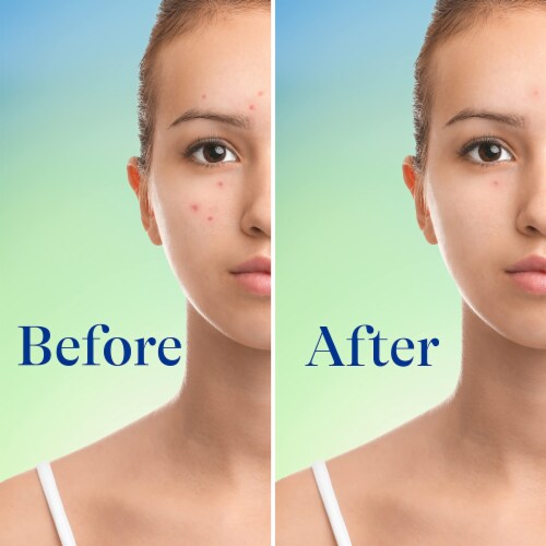 Differin Acne Face Wash with 10% Benzoyl Peroxide, (Pack of 2) Perspective: left