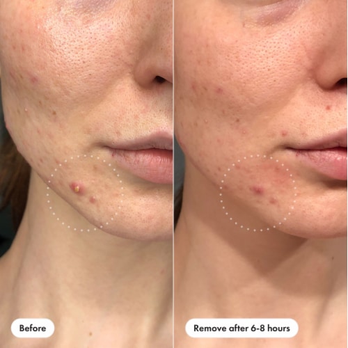 Hero Cosmetics Mighty Patch Invisible+ Acne Pimple Patches Perspective: left