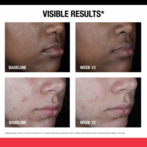 Neutrogena Stubborn Marks PM Treatment With Retinol Sa Perspective: right
