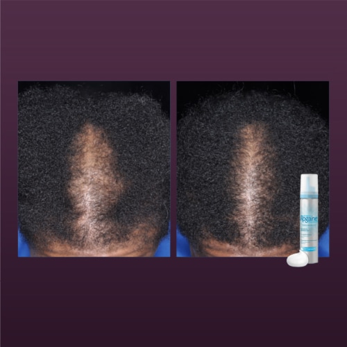 Rogaine® Women's Hair Regrowth Treatment Perspective: right