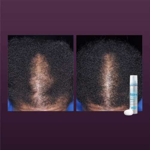 Women's Rogaine 5% Minoxidil Foam Unscented Perspective: right