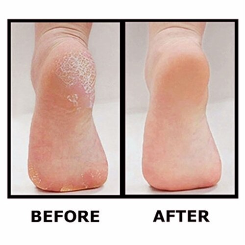 Best Pedicure Foot File - Professional Foot Callus Scrubber Perspective: right