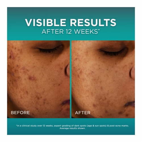 L'Oreal® Paris Bright Reveal™ 12 Percent Niacinamide Dark Spot Serum Perspective: right