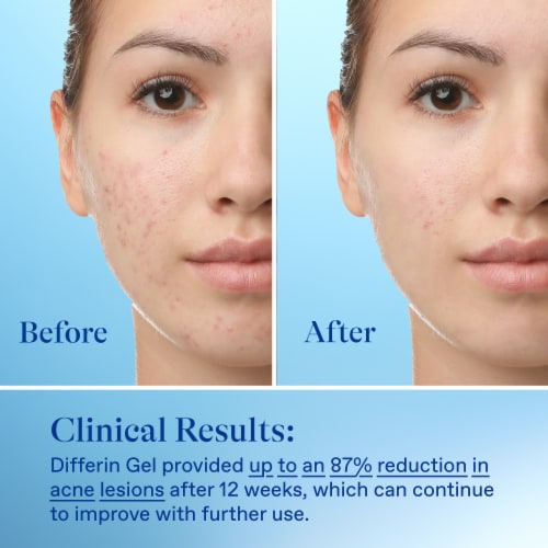 Differin 0.1% Adapalene Acne Treatment Gel, Retinoid Treatment for Face Perspective: top