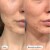 Hero Cosmetics Mighty Patch Invisible+ Acne Pimple Patches Perspective: left