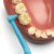 TEPE Interdental Brush Angle Cleaners - Dental Brushes Between Teeth 6 Pk, Blue .6mm Perspective: top